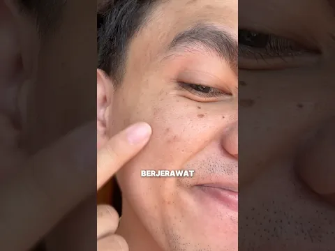 Cara ampuh hilangkan bekas jerawat 😱 #jerawat #skincare