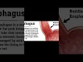 Download Lagu COMPLICATIONS of ACID REFLUX - Part 2 #gastroesophagealrefluxdisease #gerd #acidity #acidreflux #gut