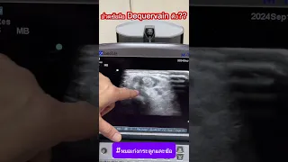  ทำไมคนไข้ถึงปวดข้อมืออย่างรุนแรงเวลาใช้นิ้วโป้งกดลง 