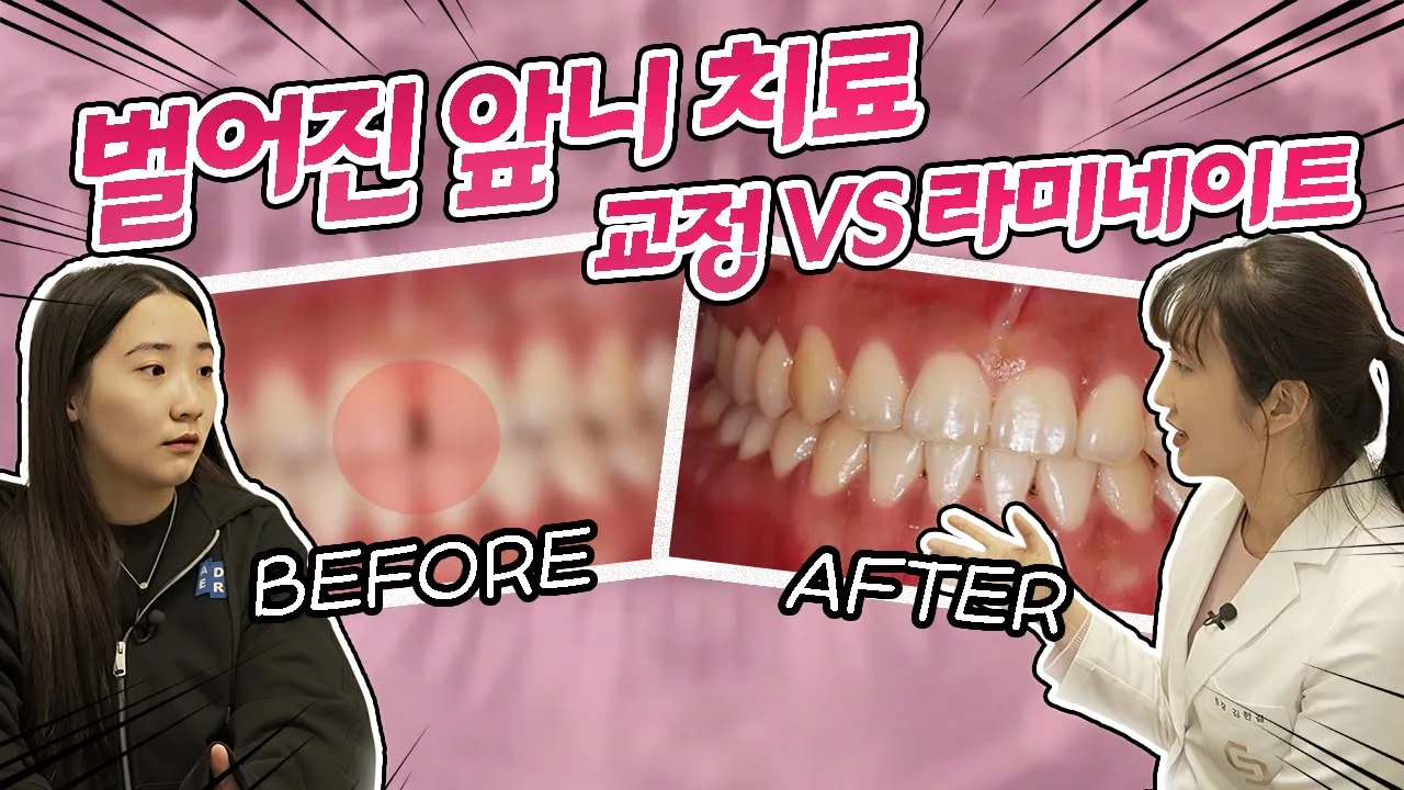 벌어진 앞니 티 안 나고 빠르게 치료하려면 교정이 나을까요, 라미네이트가 나을까요? #라미네이트 #치아교정 #임플란트 #브릿지 I 스마일뷰치과 러블리 김원장