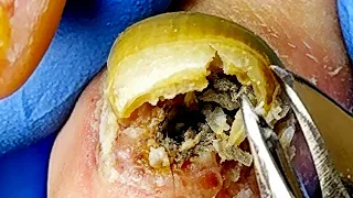 The Perfect Transformation Of Onychomycosis! Great Effect【Xue Yidao】