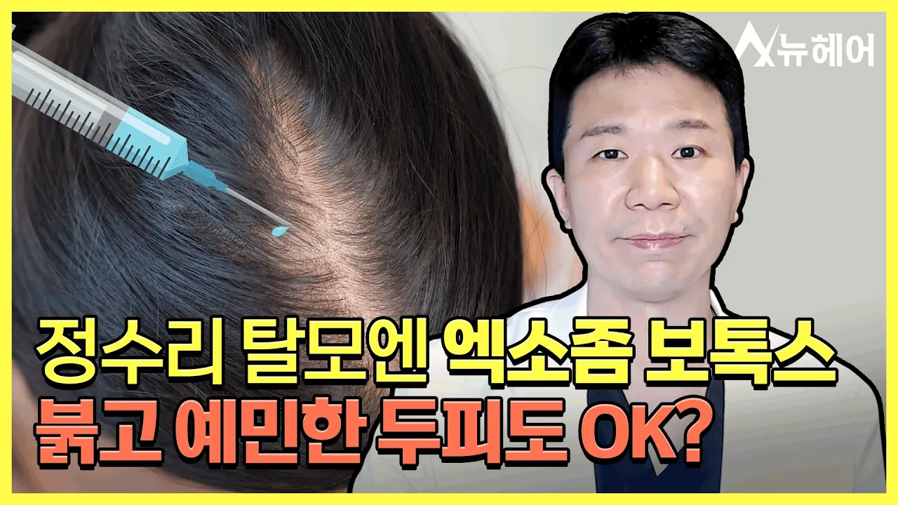 정수리 탈모에는 엑소좀 보톡스! 예민한 두피도 OK?ㅣ뉴헤어
