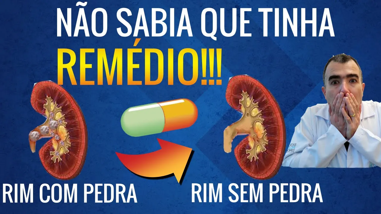 Mitos e Verdades - Cálculos Renais (Pedras nos rins) - Dr. Ravendra Moniz