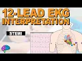 Recognize ST Elevation Myocardial Infarction STEMI on 12-lead EKG