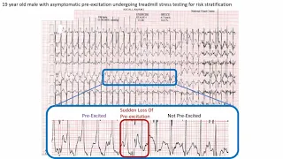 ECG In 60s Wolff Parkinson White 