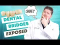 5 Things You Didn t Know About Dental Bridges but should
