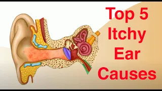 Top 5 Causes of Itchy Ears and Treatment Too