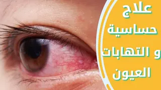 علاج حساسيه العين   التهاب الملتحمه الفيروسي  التهاب الملتحمه البكتيري   الحلقه    من كورس     دندنها