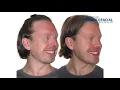 Lagu Jaw surgery Case #134: J.W - Facial asymmetry and maxillo-mandibular retrusion.