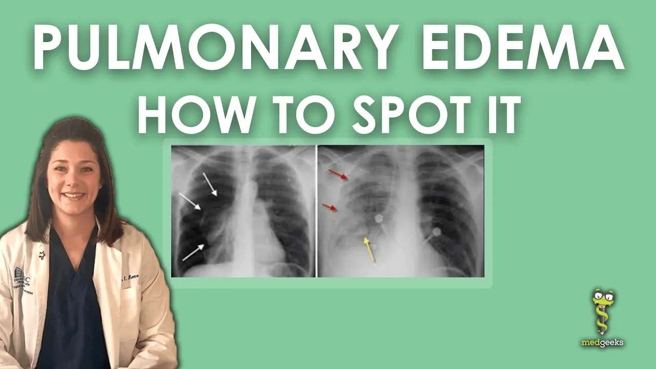 Pulmonary Edema Chest X-ray