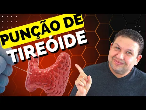 Download MP3 PUNÇÃO DE NÓDULO DE TIREÓIDE, COMO É FEITO O EXAME ! PAAF da tireóide, Punção de nódulos da tireóide