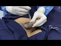 Download Lagu Non-surgical Penile Enlargement #penilefiller #biggerpenis #penisfiller