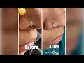 Get rid of that nose piercing bump FOR GOOD Find out what really works Easiest method