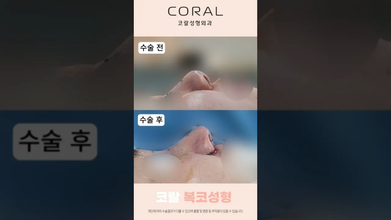 마리오 코에서 인형 코로 변신 가능? #shorts #코성형 #복코