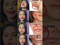 Download Lagu Face exercise to lose face fat|face tightening exercises #faceyoga #skinyoga#facialyoga #facemassage