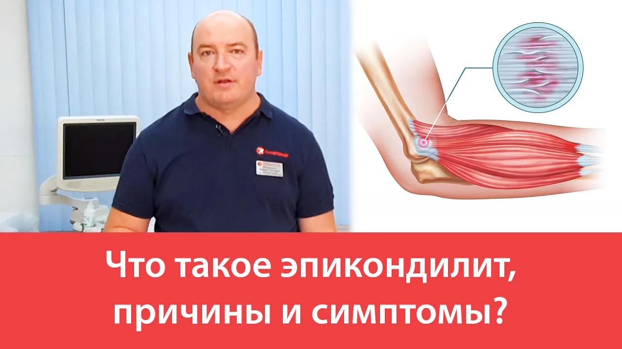 Лечение эпикондилита локтевого сустава мази. Эпикондилит: симптомы, причины, лечение эпикондилита локтевого сустава. Лечение Эпикондилита Плечевого Сустава — Buy-artox.ru Латеральный эпикондилит - KinesioPro