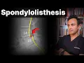 Spondylolisthesis Is Surgery Necessary