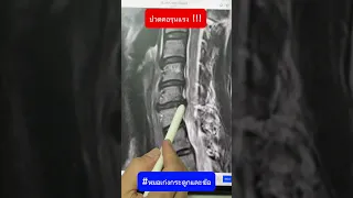  ทำไมผู้ป่วยถึงมีอาการปวดต้นคอและร้าวลงสะบักซ้าย 