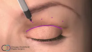 CO2 Laser Upper Blepharoplasty Animation