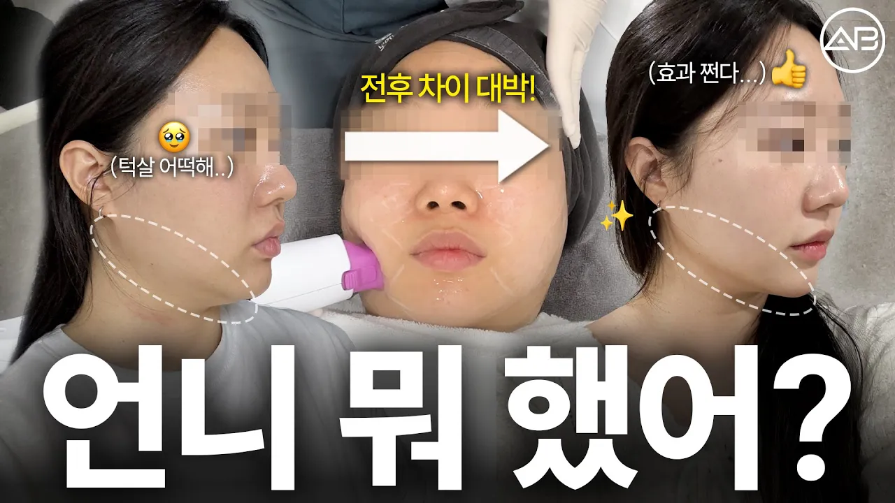 30대 피부 시술 두 가지로 정리하세요!