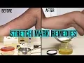 HOW TO GET RID OF STRETCH MARKS SCARS DIY AT HOME STRETCH MARK CREAM
