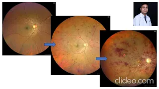 what is diabetic retinopathy in bengali by dr mukesh jain retina specialist kolkata