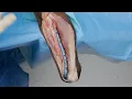 Distal Humerus Shaft Fracture Fixation Using the Arthrex Elbow Plating System