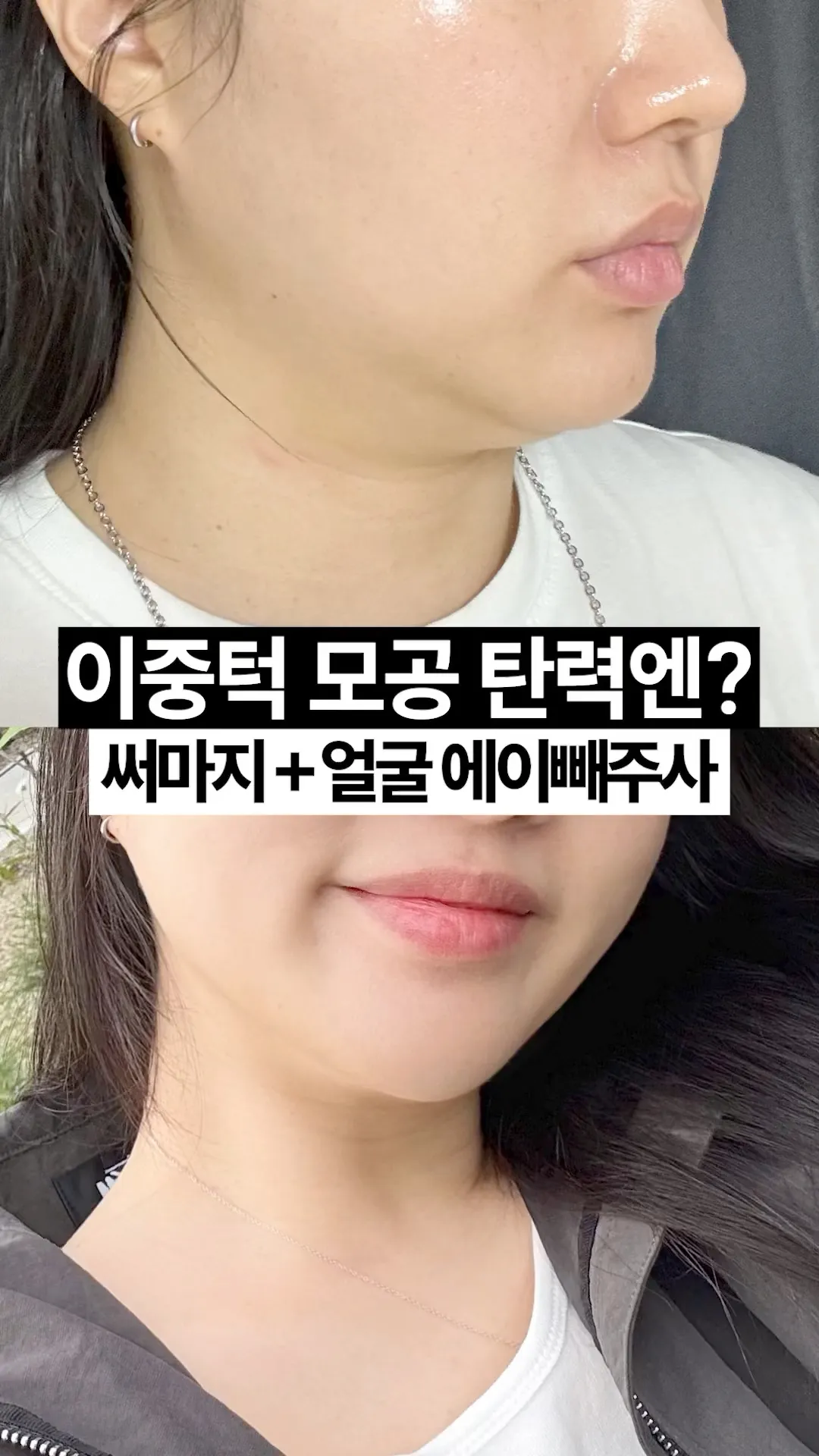 30대 피부 시술 추천 💗