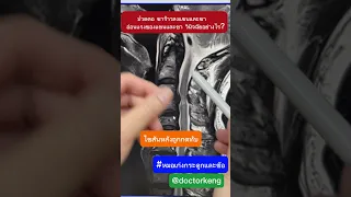  ทำไมคนไข้ถึงมีอาการปวดต้นคอและชาลงแขน 