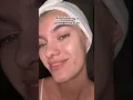 Rule of popping pimples without scarring it will reduce the potential damage