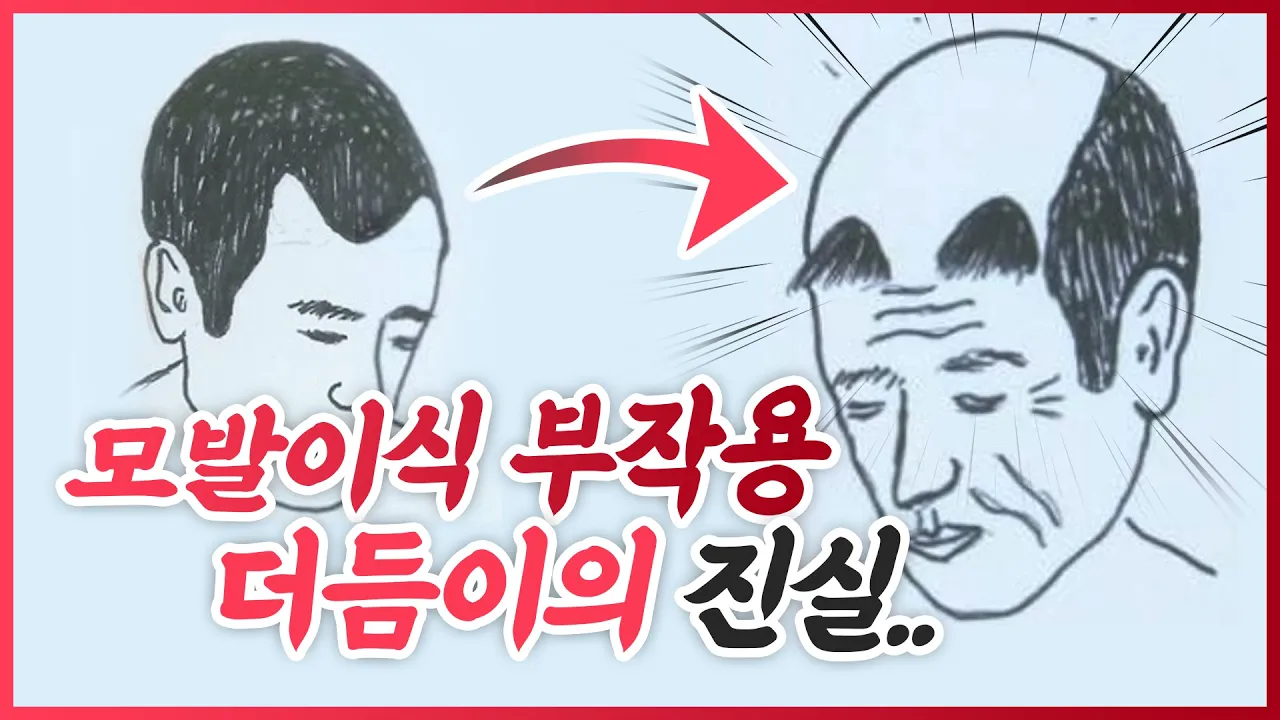 모발이식하고 탈모 오면 이렇게 된다ㅣ더듬이ㅣ부작용 [모발이식][모발이식 후기]