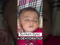 Lagu Dehydration Sign #dehydration #infants #babies #diarrhea #sunkeneyes
