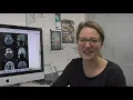 MCRI s NAD P HX dehydratase NAXD deficiency discovery