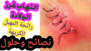 أسباب التهاب وتورم جرح الولادة الطبيعية  تعفن الغرز متى يمكن ان يحدت هذا الالتهاب دندنها