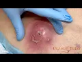 Drainage of a large infected epidermal cyst - Happy Easter
