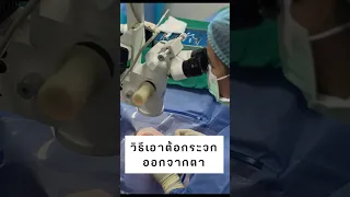 การผ่าตัดสลายต้อกระจกมีวิธีใดบ้าง และแต่ละวิธีใช้เมื่อไหร่