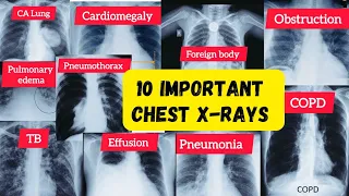 important chest xray radiology chest pulmonology neetpg fmge usmle