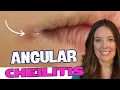 Best Lip Treatment for Angular Cheilitis Dermatologist Advice