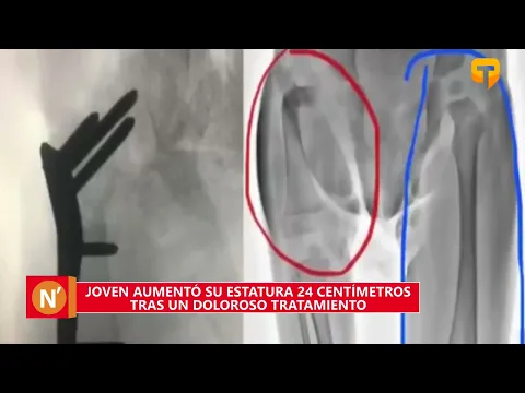 Joven aumentó su estatura 24 centímetros tras un doloroso tratamiento