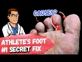 BEST Athlete's Foot Fungus Treatments [HOME Remedies + 3 BIG SECRETS]