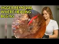 Immediate Healing Through Jigger Removal