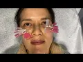 Smooth Threads for Under-eye Rejuvenation by Dr Tsay - Ageless MD