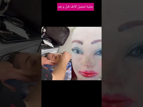 عملية تجميل الاتف قبل و بعد #مكياج_سينمائي #makeupartist #تجميل #مايكاب