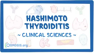 Hashimoto thyroiditis