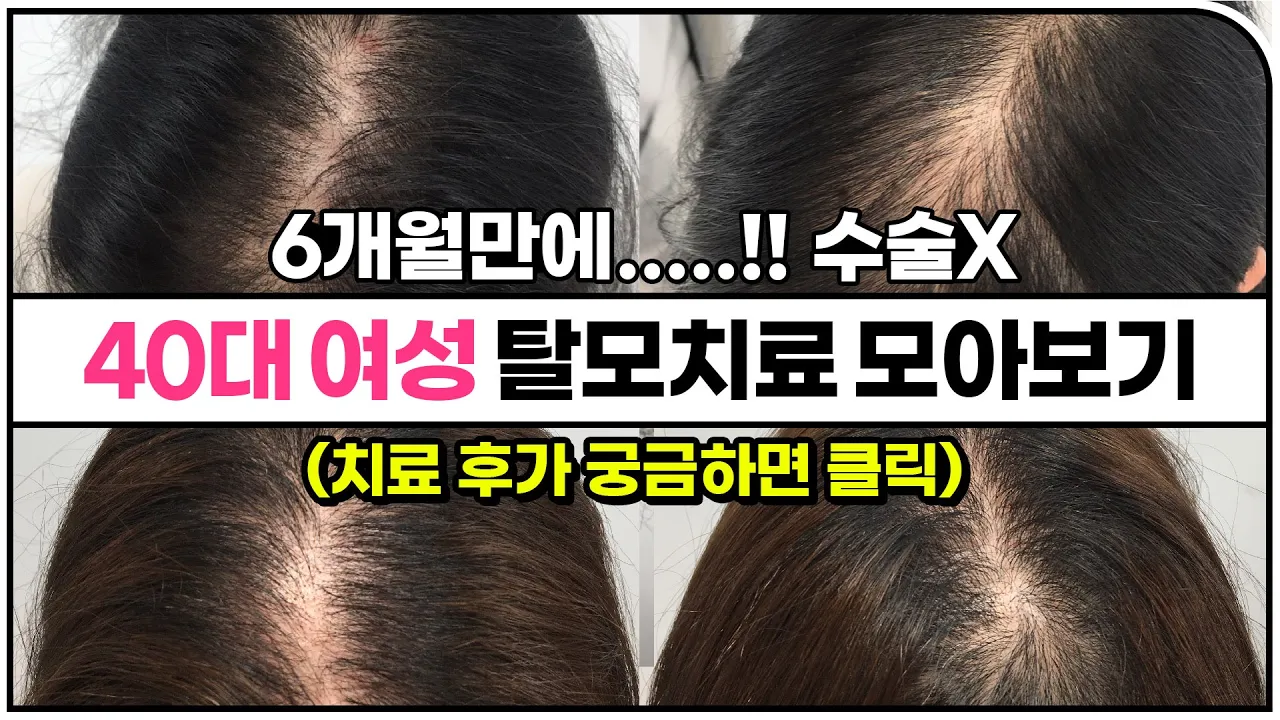 40대 여성 탈모치료 모음! 6개월 결과가 이 정도라고? (수술 안 했음)ㅣ뉴헤어