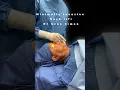 Minimally Invasive Neck lift Demonstrated - STEP by STEP with Miami Plastic Surgeon Sean Simon MD