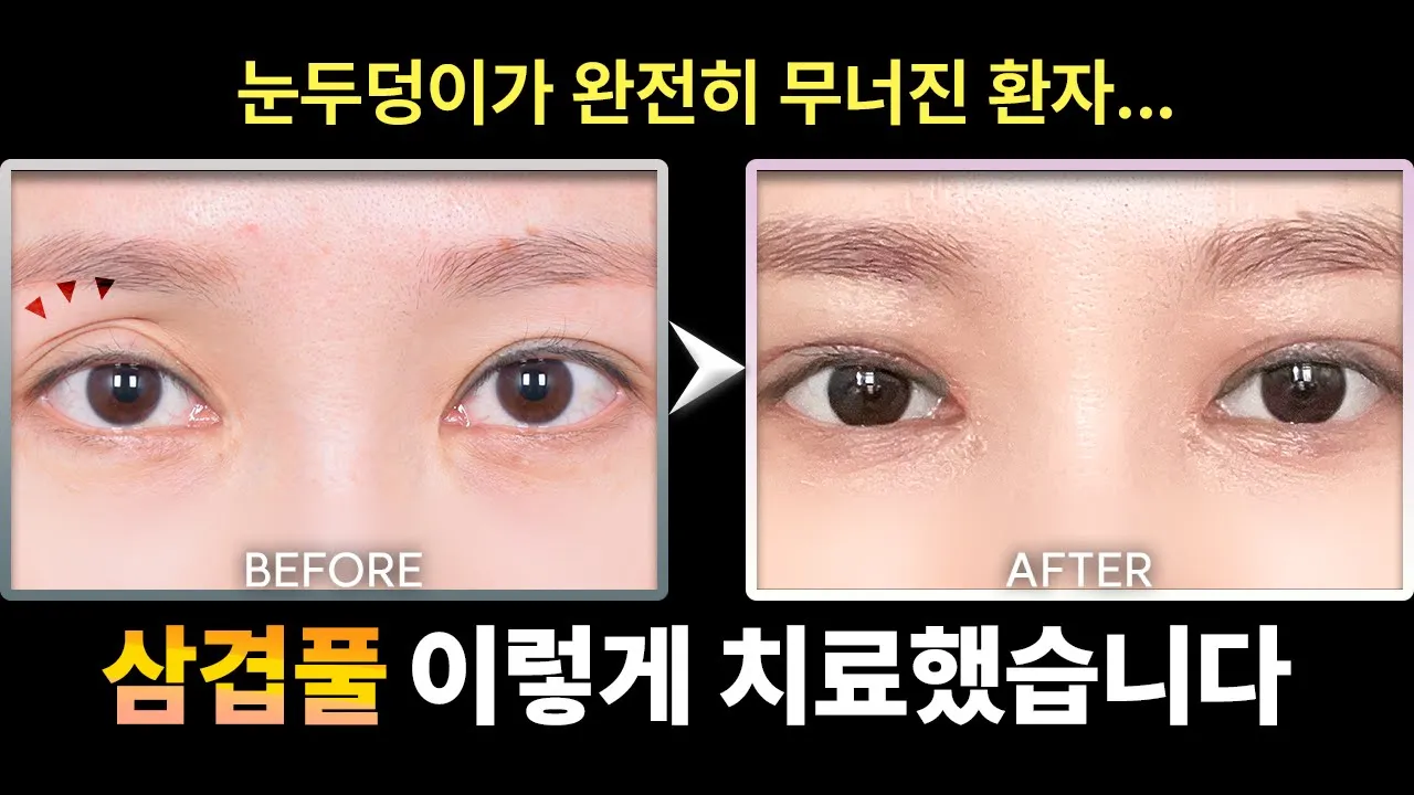 [성형리뷰] 비대칭 삼겹풀 환자, 쌍꺼풀 재수술 해드렸습니다