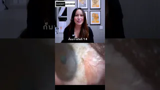  ผลแทรกซ้อนที่พบบ่อยที่สุดหลังการผ่าตัดต้อเนื้อคืออะไร และเกิดขึ้นกับคนไข้กี่เปอร์เซ็นต์ 