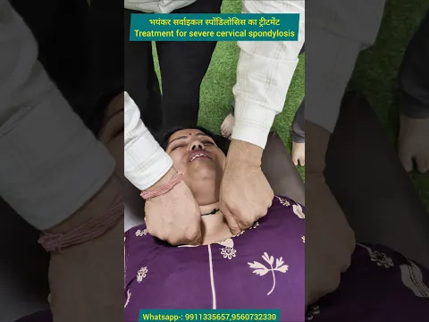 भयंकर सर्वाइकल स्पोंडिलोसिस का ट्रीटमेंट। Treatment for severe cervical spondylosis. #cervical