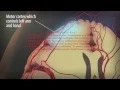 Download Lagu 3D Transient Ischemic Attack and Stroke